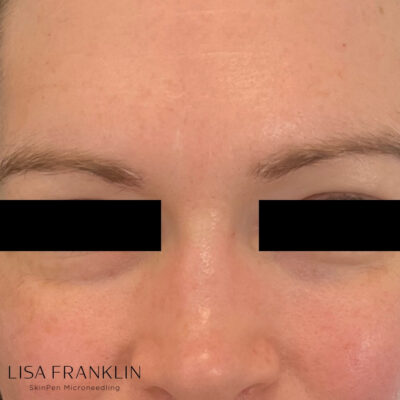 Smooth, radiant skin with reduced acne scars and fine lines after SkinPen Microneedling treatment.