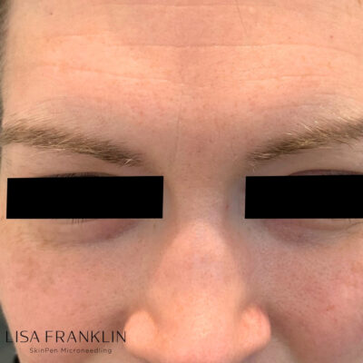 Close-up of skin with fine lines, acne scars, and uneven texture before SkinPen Microneedling treatment.