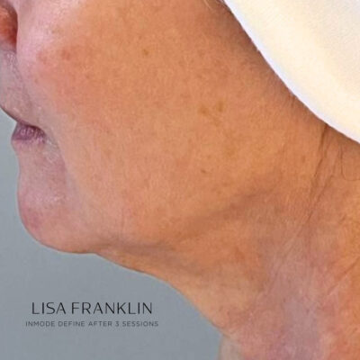 Enhanced facial contours and improved skin firmness after InMode Define treatment.