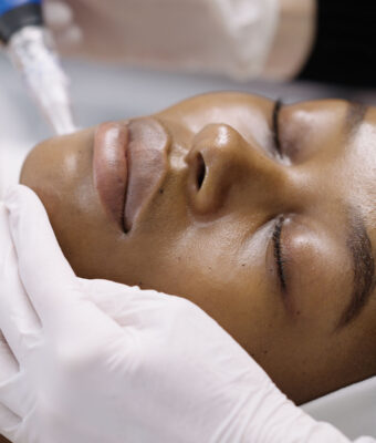 collegen banking micro needling treatment