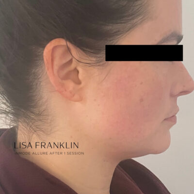 Tighter, lifted skin after a InMode Allure skin-tightening treatment.