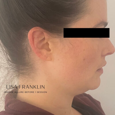 Sagging skin double chin on the face before undergoing InMode Allure radiofrequency treatment.