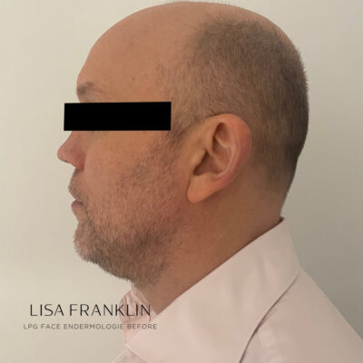 Puffiness and visible signs of fatigue, double chin before LPG Face Endermologie treatment.