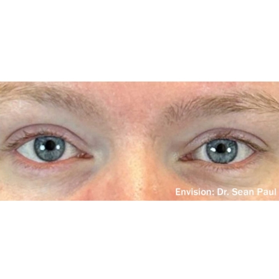 Male patient after Envision IPL and RF therapy, showing clearer eyes, reduced eyelid redness, and improved hydration and comfort.