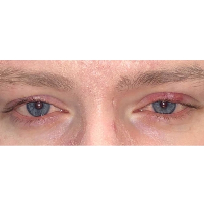 Male patient before Envision dry eye treatment, showing red, inflamed eyelids and visible signs of blepharitis and Meibomian gland dysfunction.