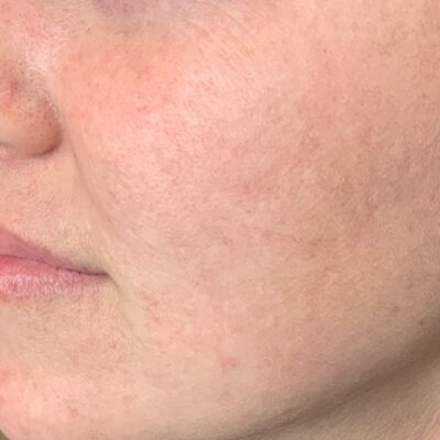 Close-up of visibly clearer, even-toned skin after Lumecca IPL treatment at Lisa Franklin, showing reduced hyperpigmentation