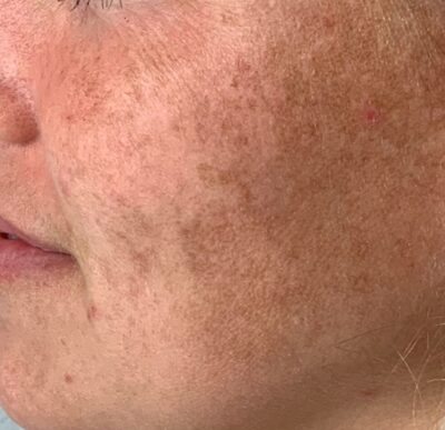 Close-up of skin with pigmentation before Lumecca IPL treatment at Lisa Franklin London.