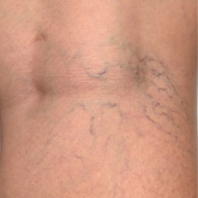 Close-up image of thread veins and spider veins on the back of a leg, showing visible vascular imperfections before treatment.